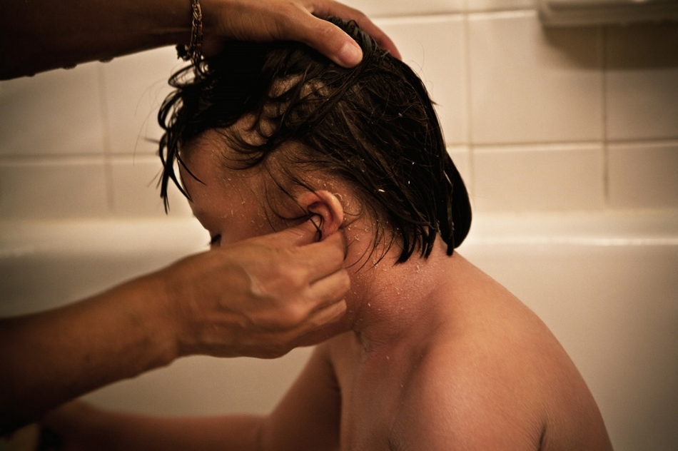 孤兒?。呼~鱗病女孩的艱難生活【圖】