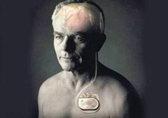 起搏器真的能治好帕金森病嗎？