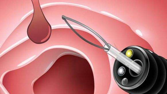 【健康解碼&middot;小貼士】檢查出息肉 需要切除嗎？